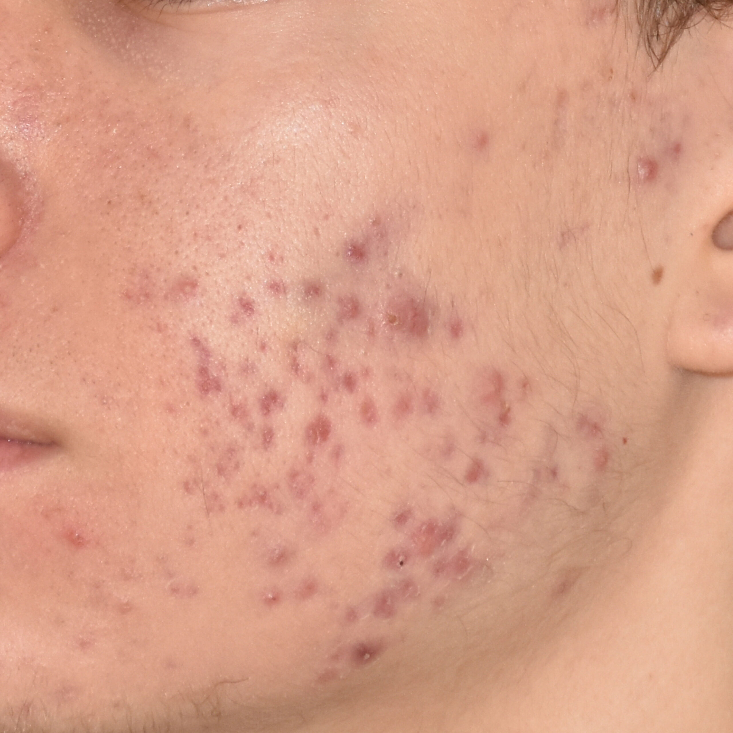 Case--8164 | Before Face Treatments 4