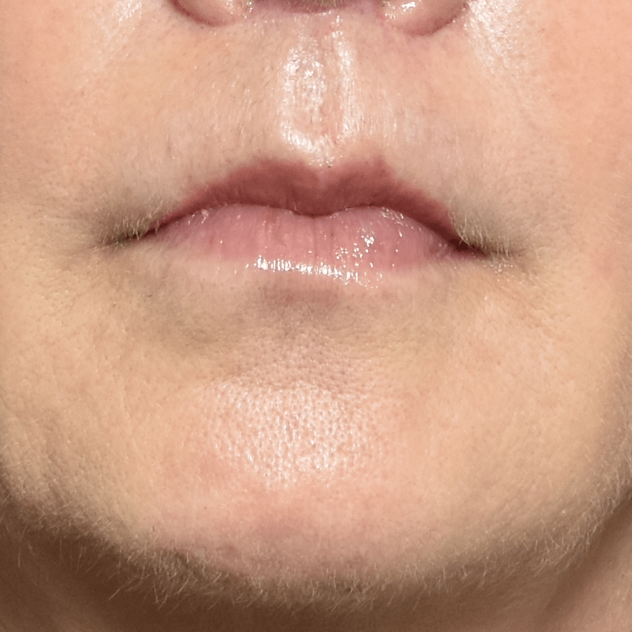 After image of a patient