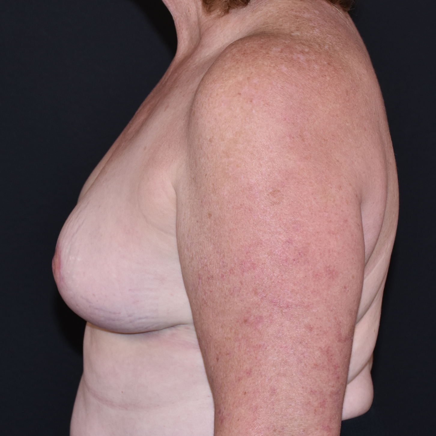 Case--5625 | After Breast Reduction 2