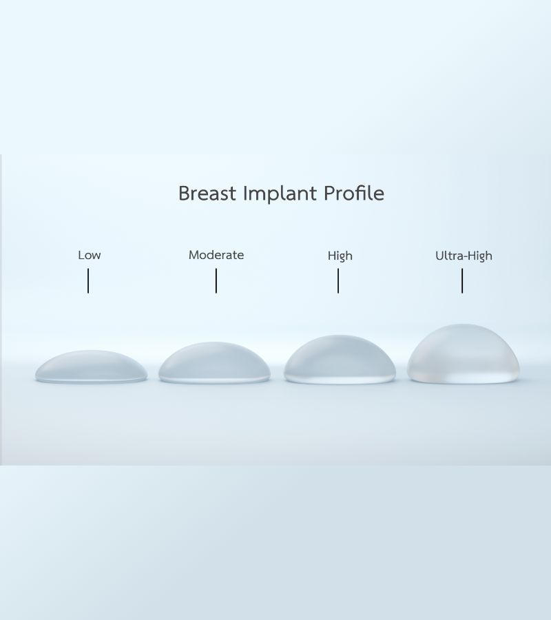 breast implant profile | Lake Oswego Portland Oregon Burgess Plastic Surgery
