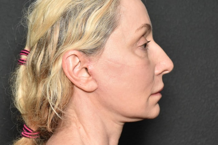Facelift and Neck Lift – Case 1