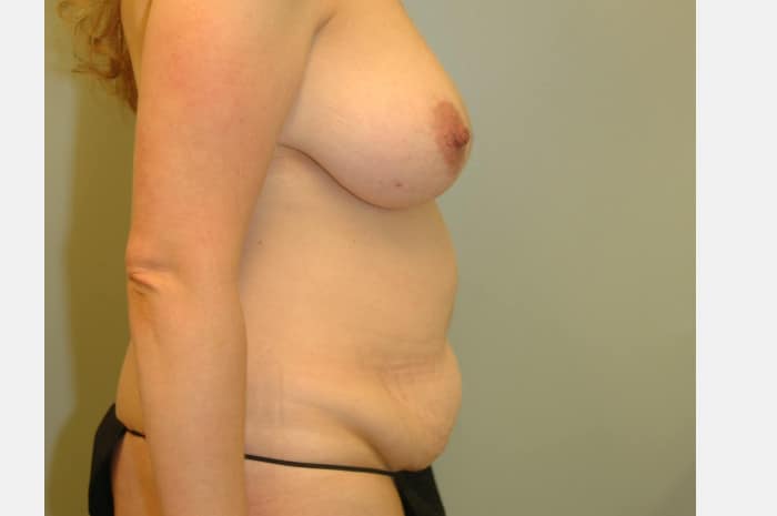 Lower Back Liposuction and Abdominoplasty