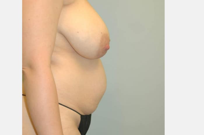 Breast Reduction and Abdominoplasty