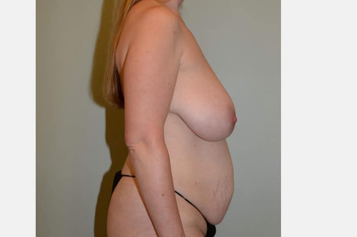 Vertical Breast Reduction and Abdominoplasty