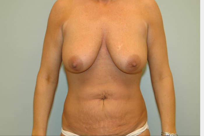 Vertical Lift and Tummy Tuck