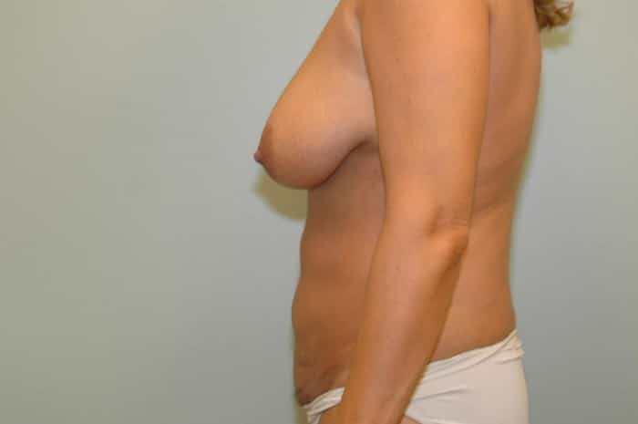 Vertical Lift and Tummy Tuck