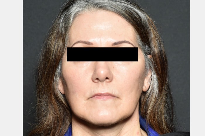Face and Necklift