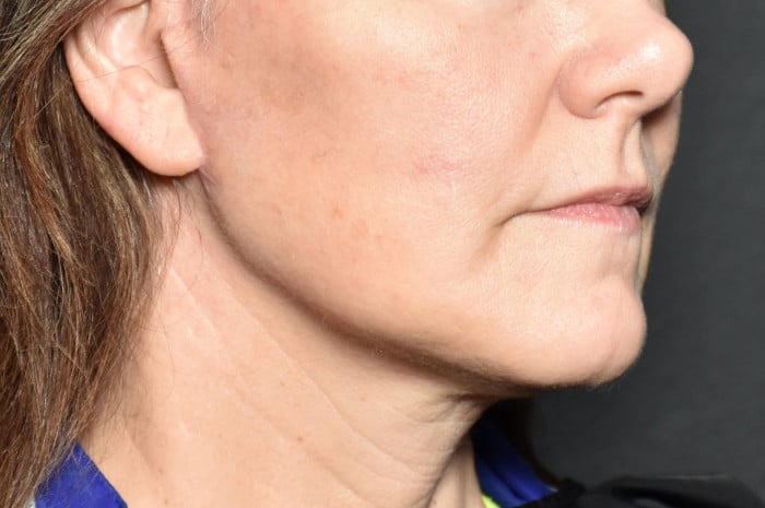 Face and Necklift