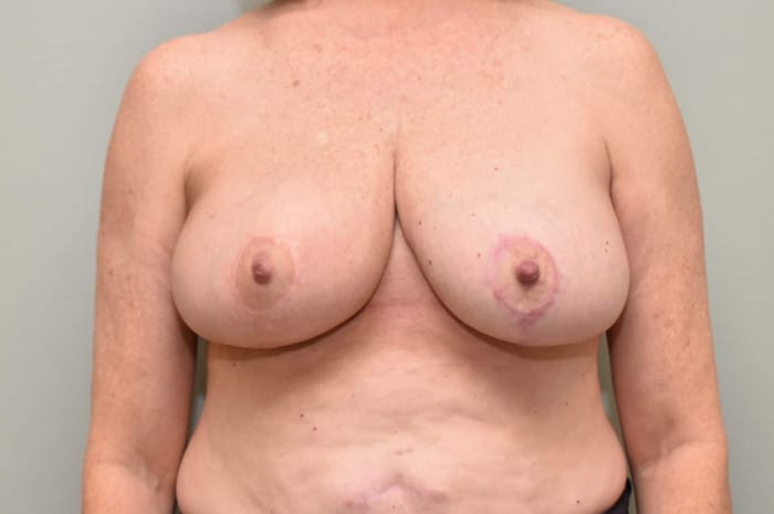 Breast Reduction/Reconstruction