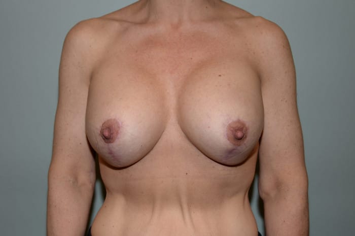 Breast Augmentation With a Lift and a Brachioplasty