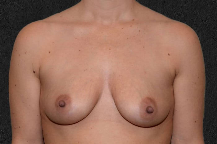 Breast Augmentation with Implants