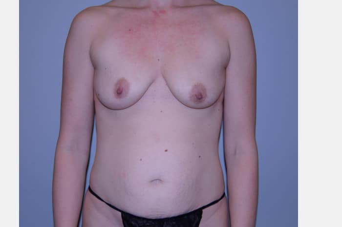 Breast Augmentation With Lift and Abdominoplasty
