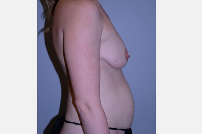 Breast Augmentation With Lift and Abdominoplasty
