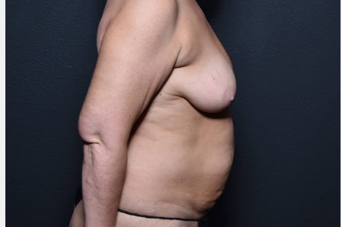 Tummy Tuck, Breast Augmentation with Lift, Axillary Liposuction