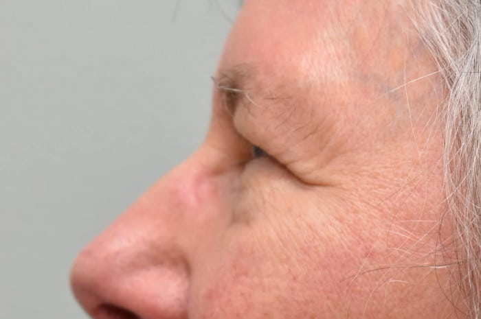 Upper Blepharoplasty and Endoscopic Brow Lift