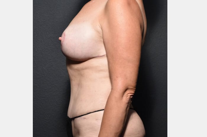 Breast Augmentation with a Lift and Tummy Tuck