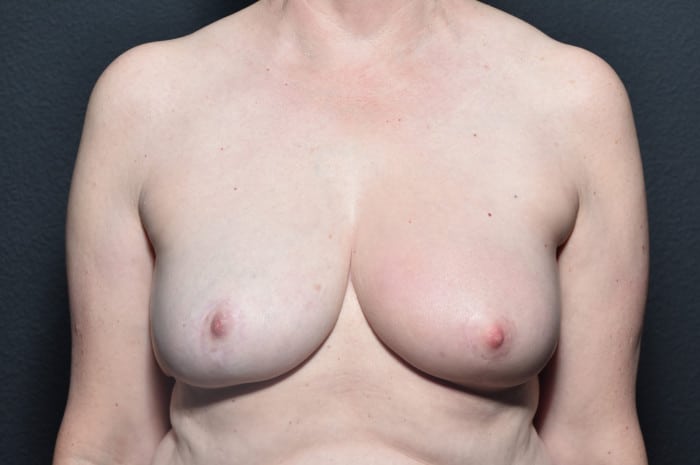 Breast Reduction with Lumpectomy