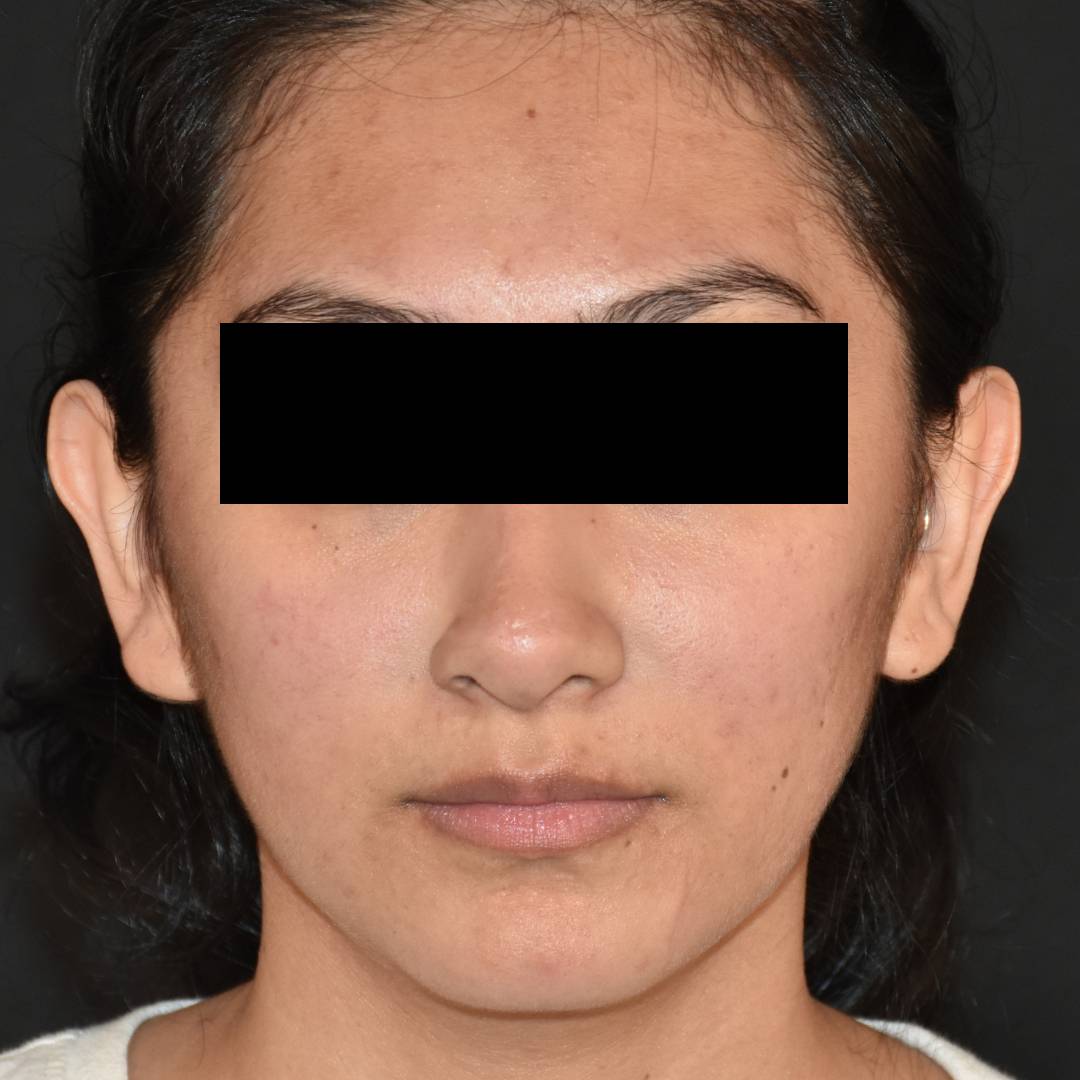 Case--1984 | Before Ear Pinning