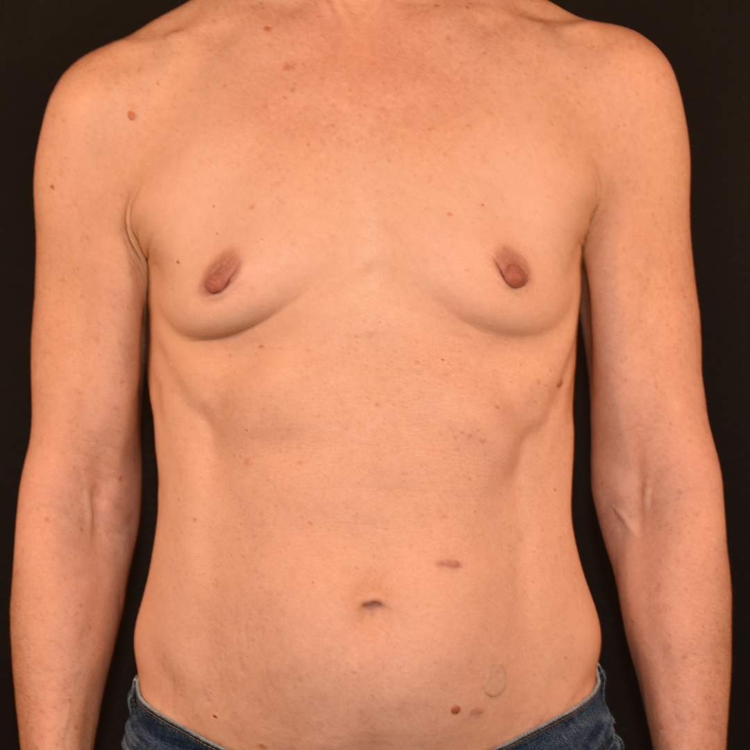Case--3332 | Before Breast Augmentation