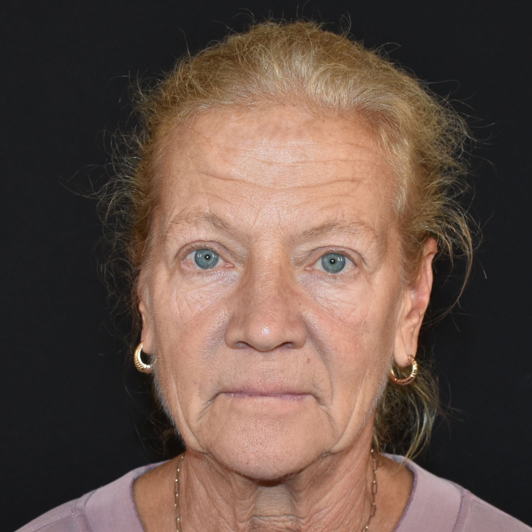 Case--4846 | Before Medspa