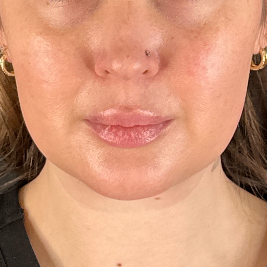 Case--6431 | Before Facial Fillers 1