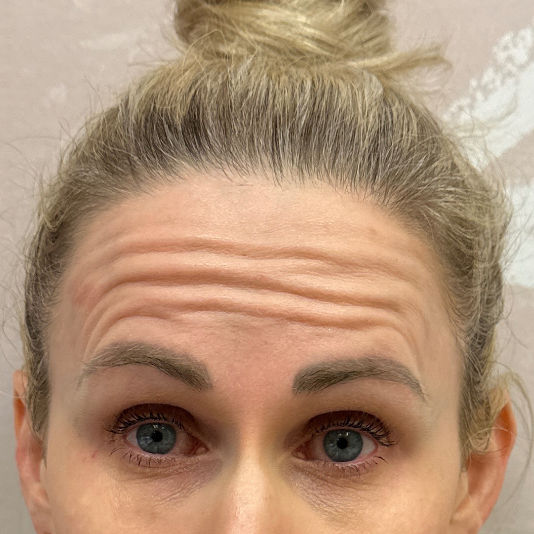 Case--4212 | Before Medspa