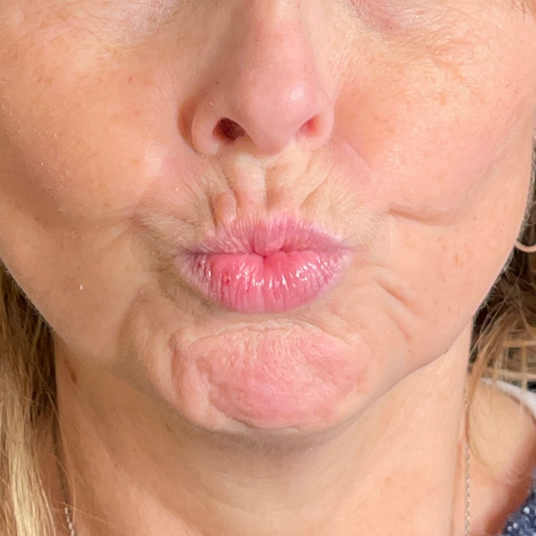 Case--4622 | Before Facial Fillers