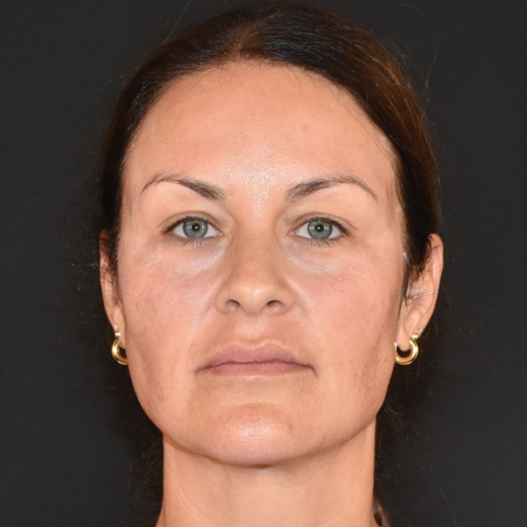 Case--3321 | Before Facial Fillers