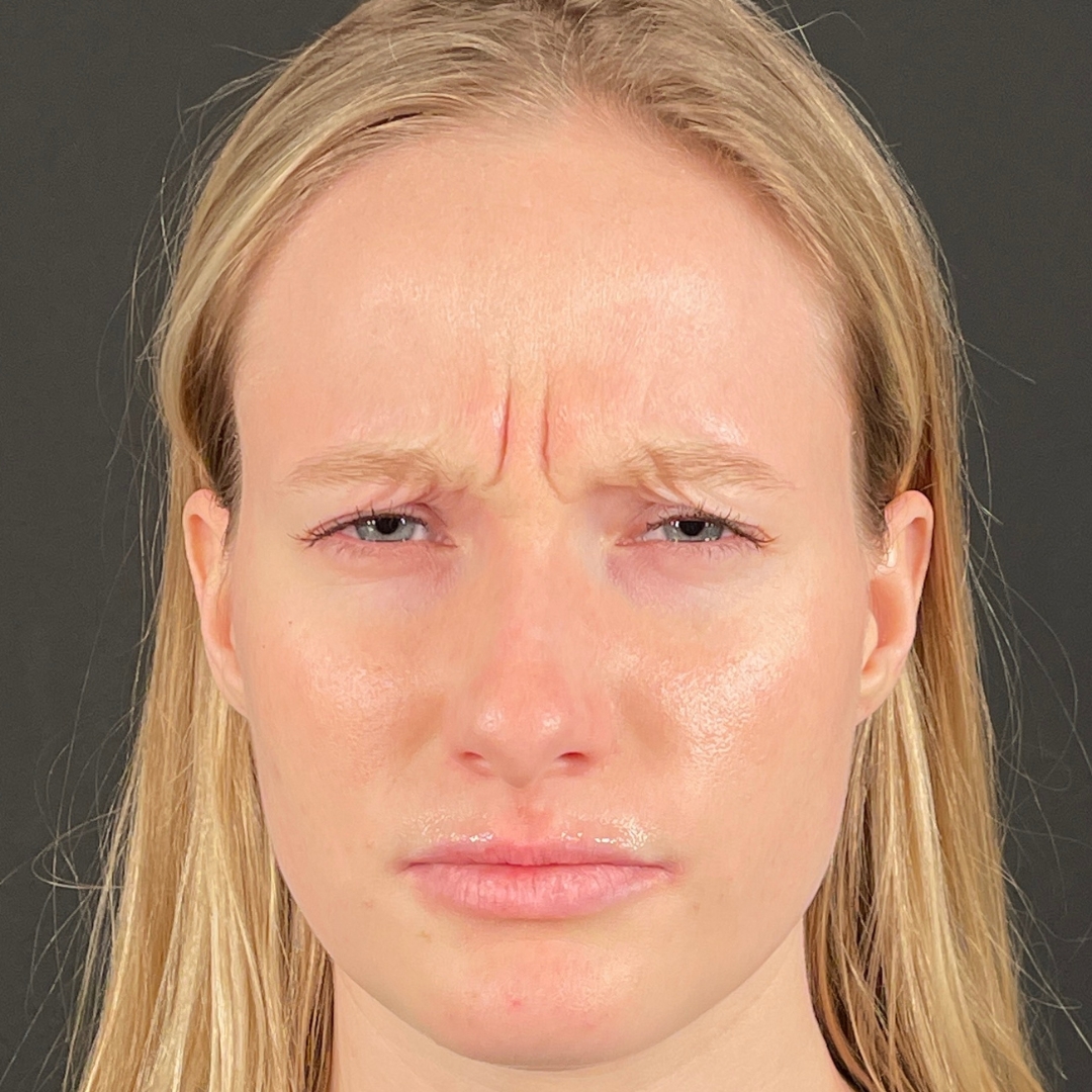 Case--6544 | Before Neurotoxins