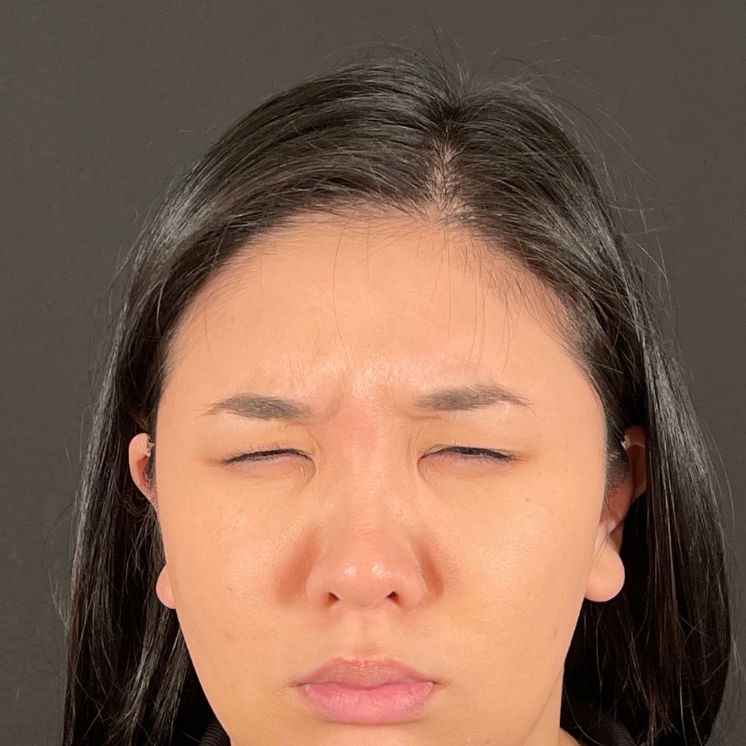 Case--6583 | Before Neurotoxins