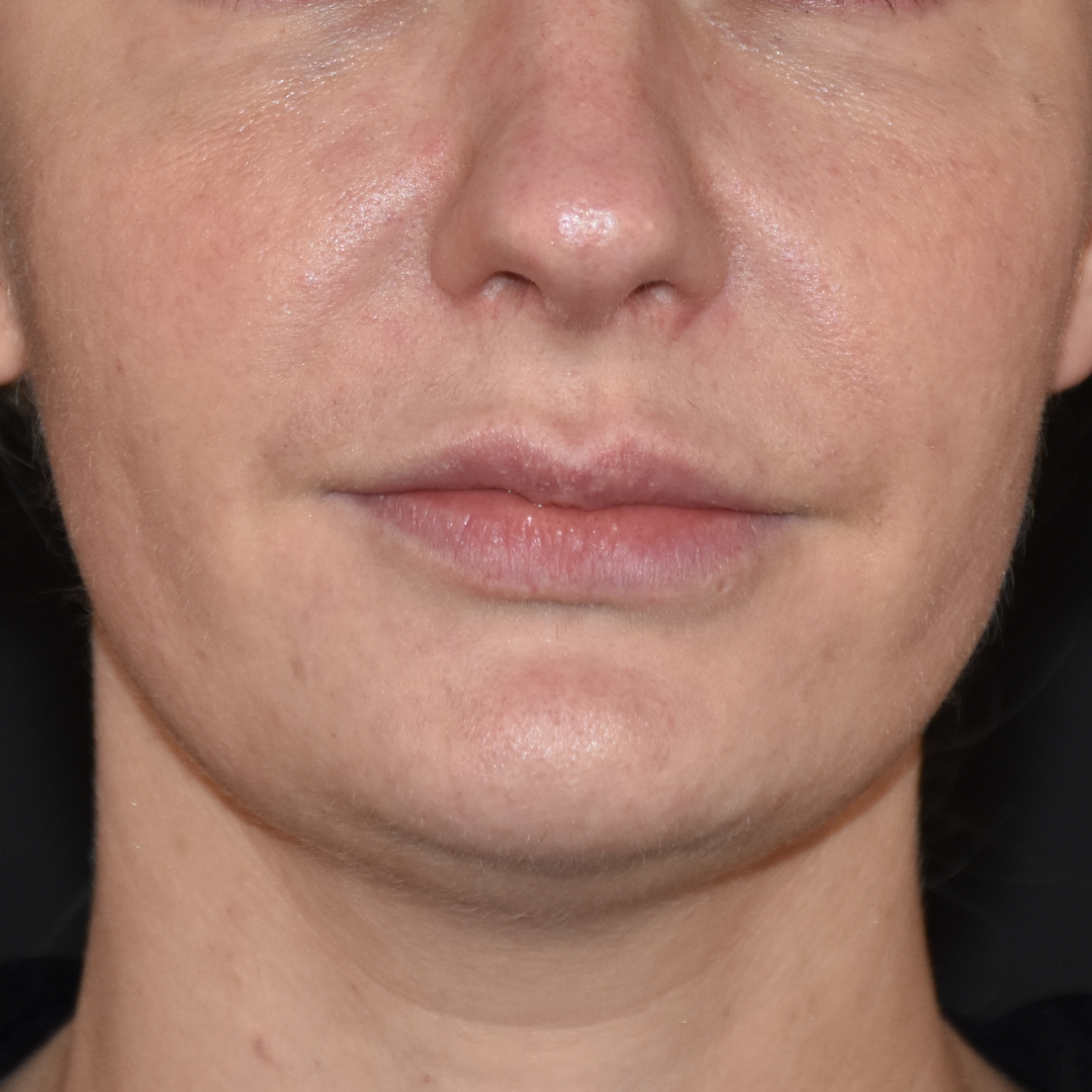 Case--2605 | Before Ultherapy 2