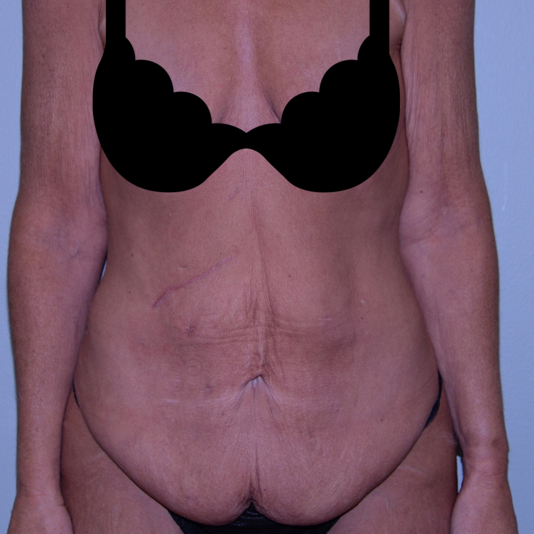 Case--5404 | Before Massive Weight Loss