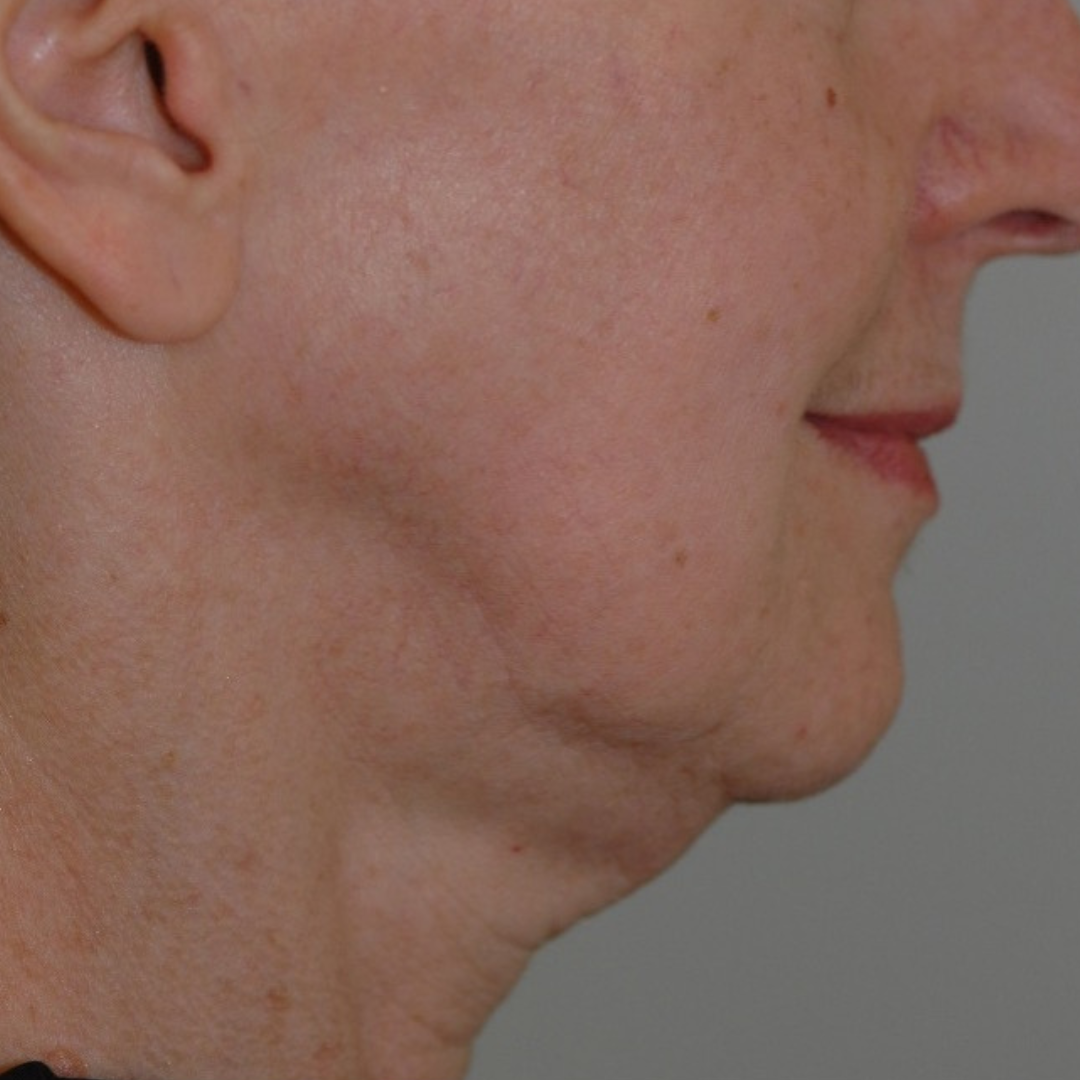 Case--4557 | Before Medspa