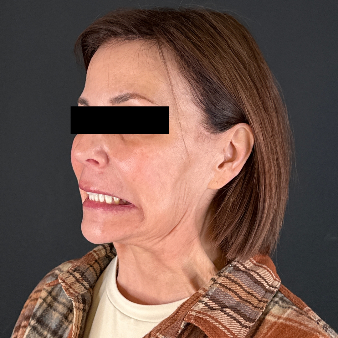 Case--6842 | Before Neurotoxins