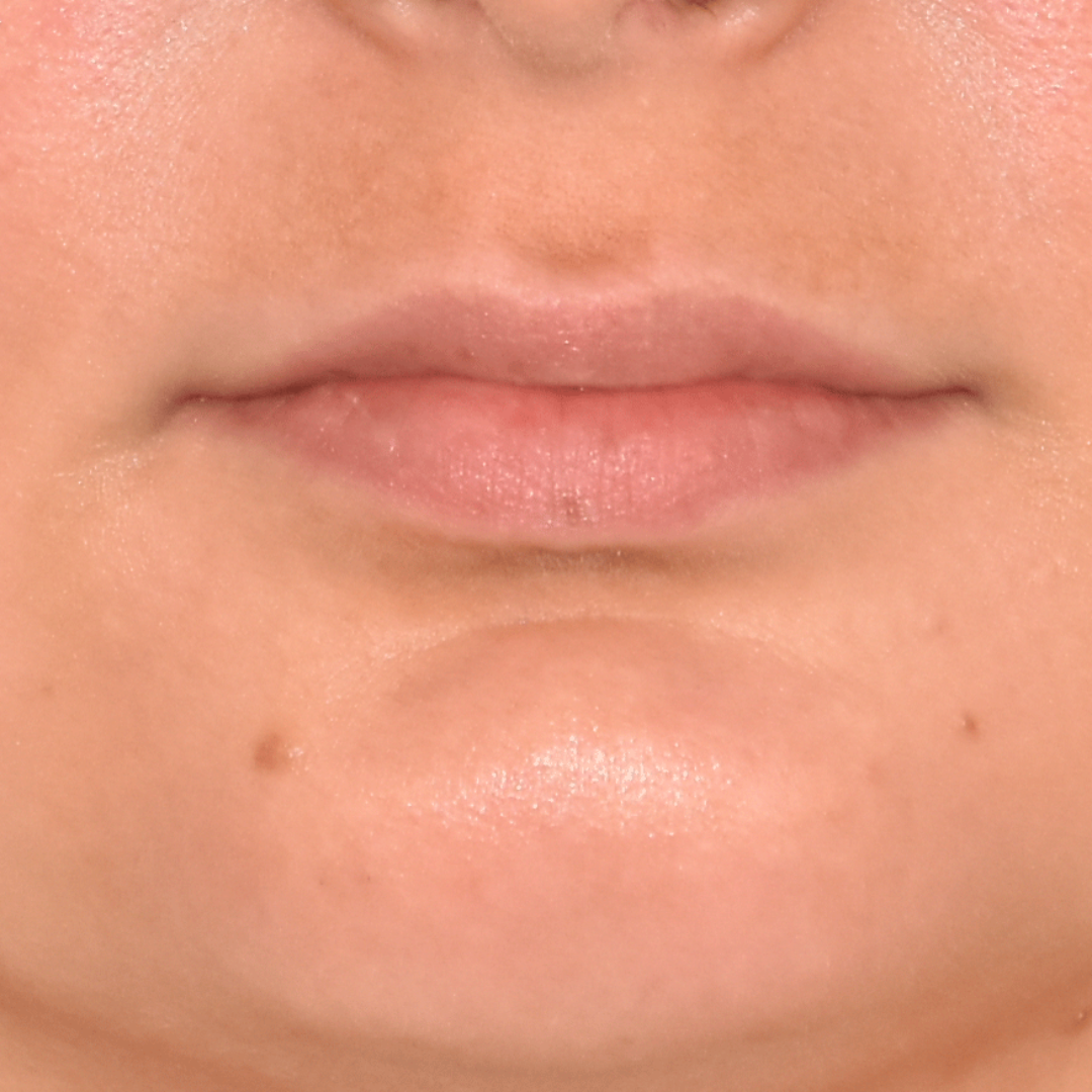 Case--8065 | Before Facial Fillers 2