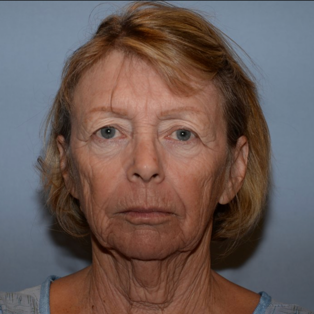 Case--2128 | Before IPL & Laser Treatments