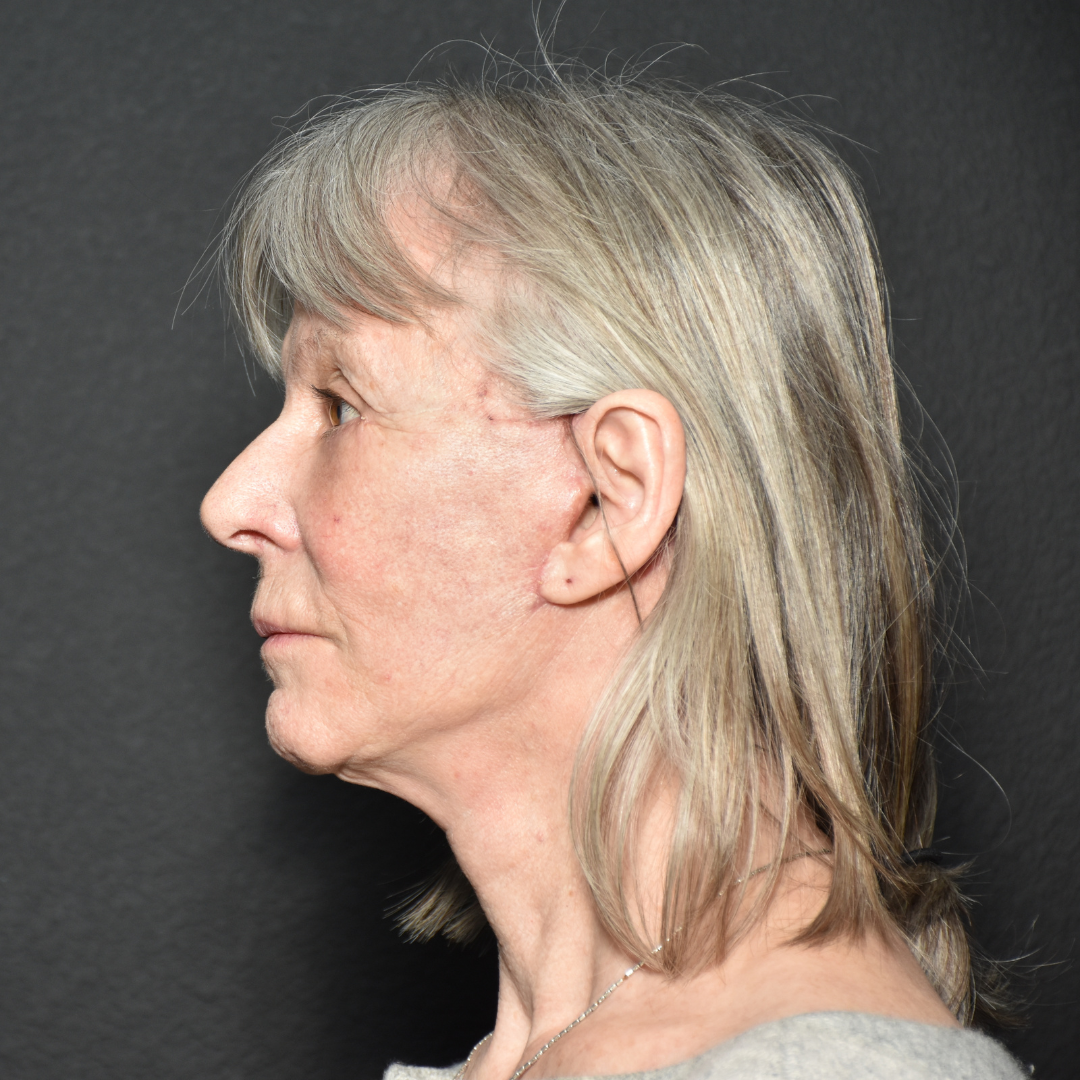 Case--5450 | After Facelift and Neck Lift 2