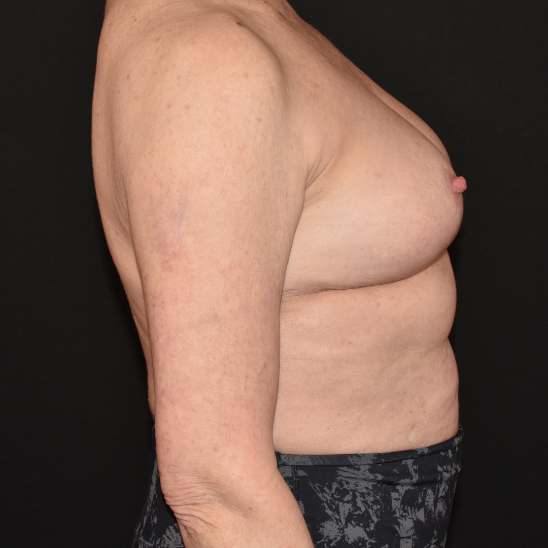 Case--6940 | After Breast Reduction 5
