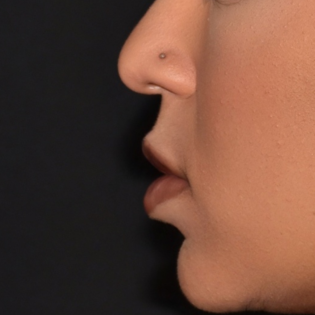 Case--9574 | After Facial Fillers 2