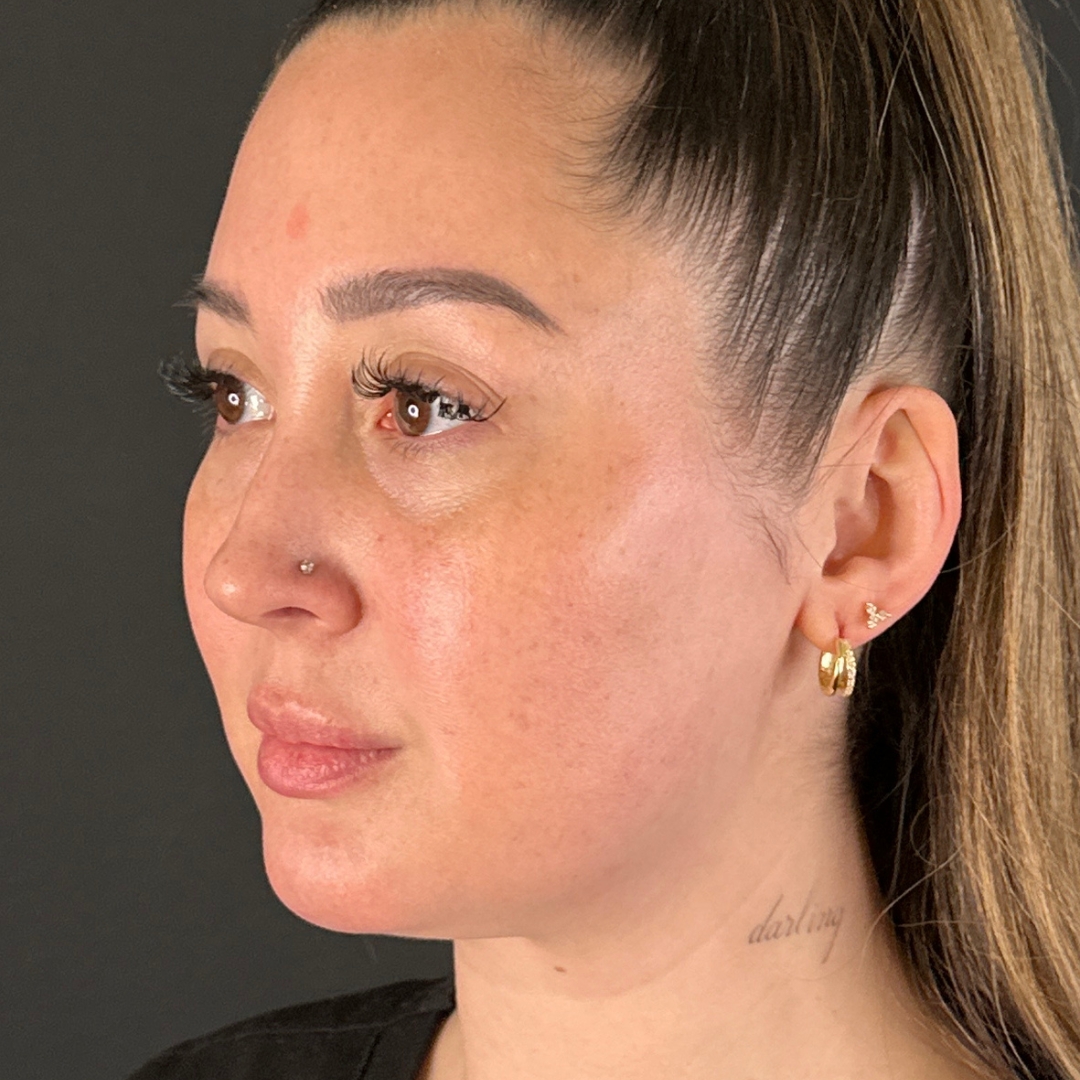 Case--1005 | Before Ultherapy 2