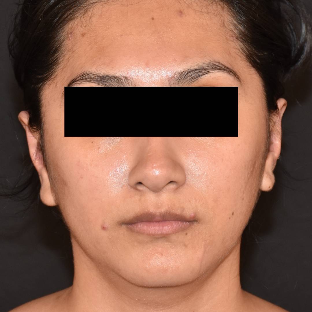 Case--1984 | After Ear Pinning