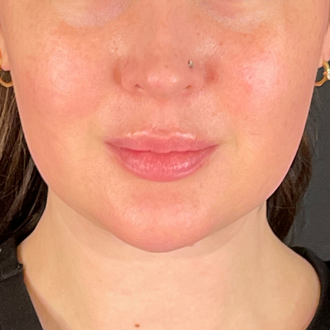 Case--6431 | After Facial Fillers 1