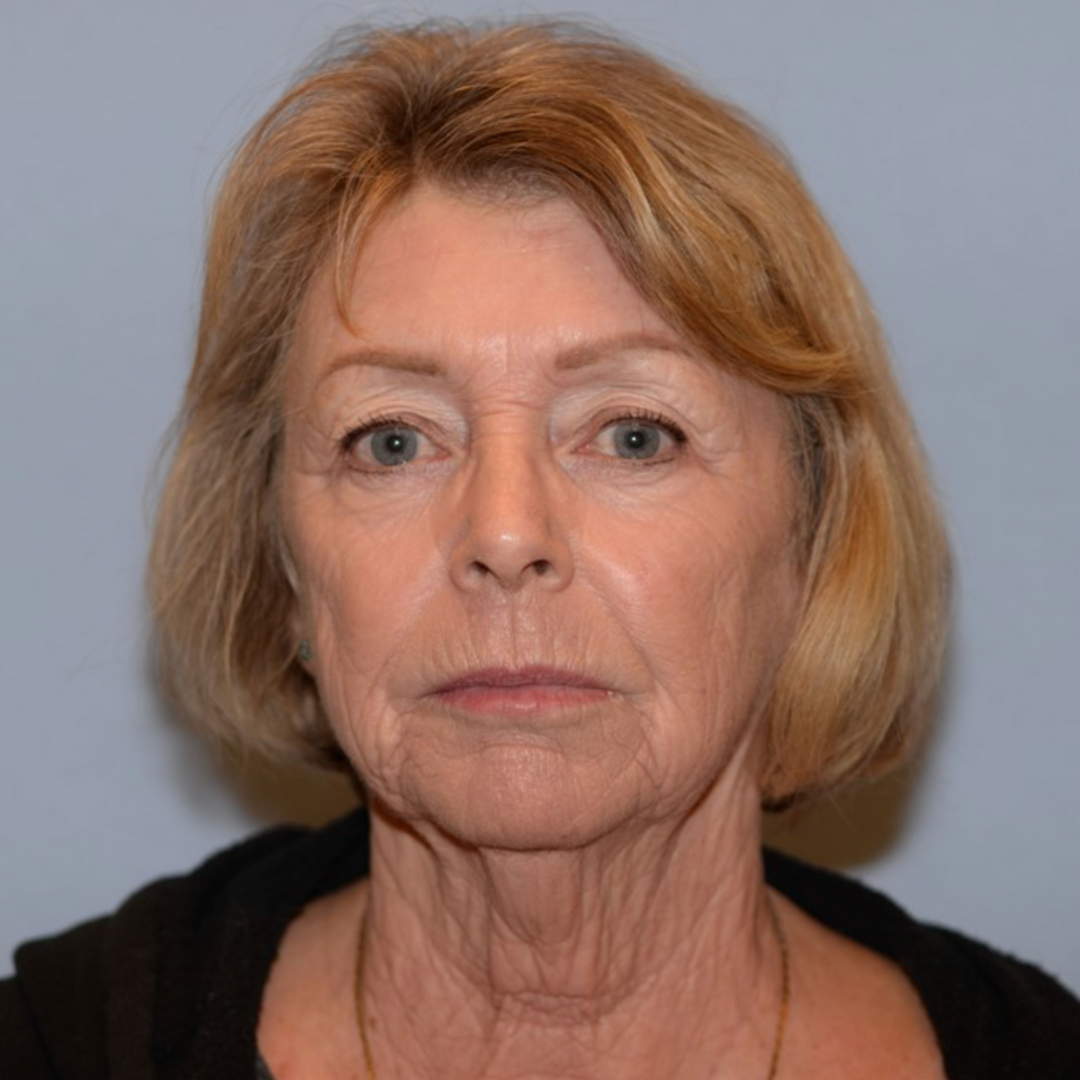 Case--2128 | After IPL & Laser Treatments