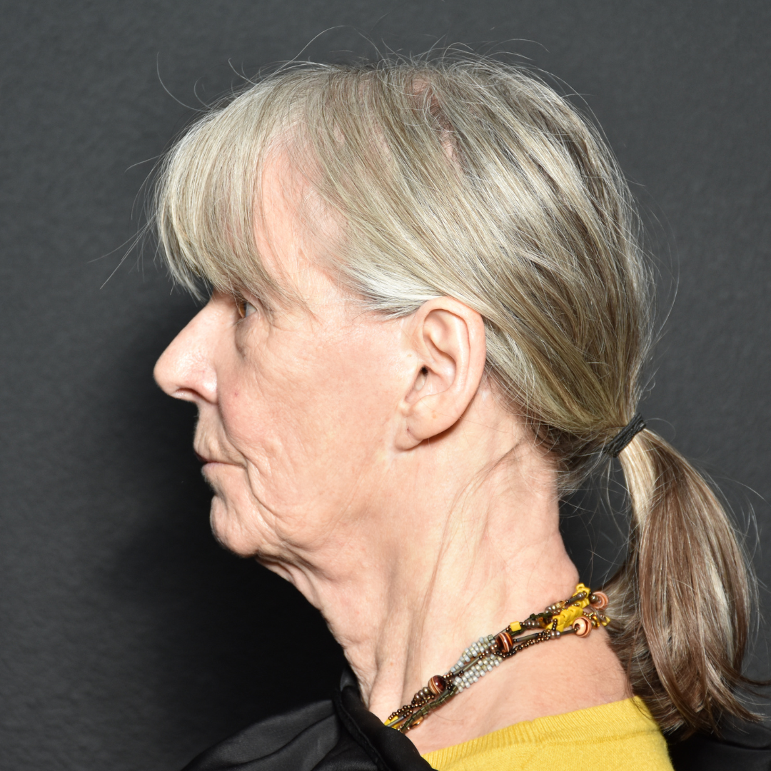 Case--5450 | Before Facelift and Neck Lift 2