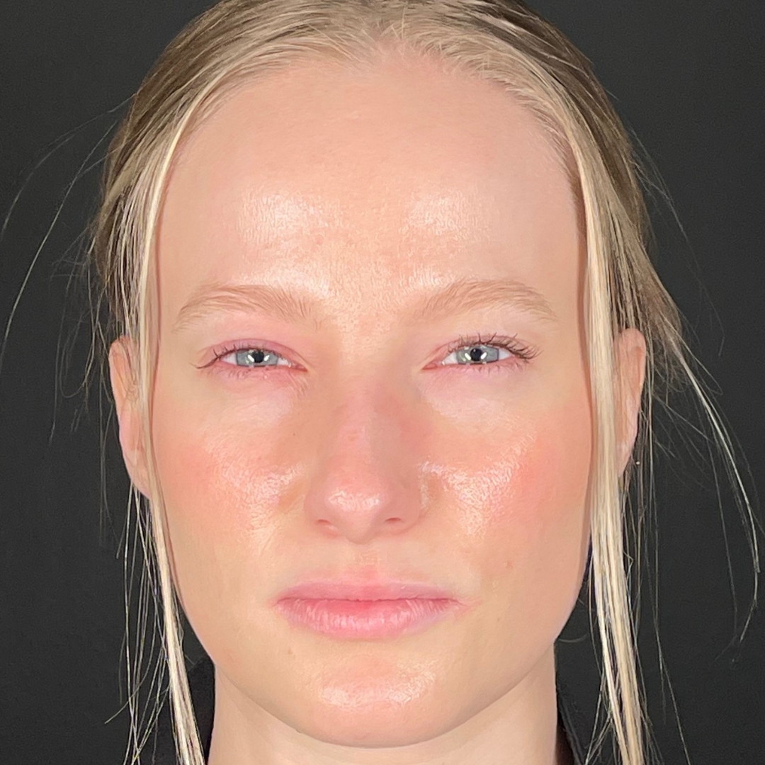 Case--6544 | After Neurotoxins