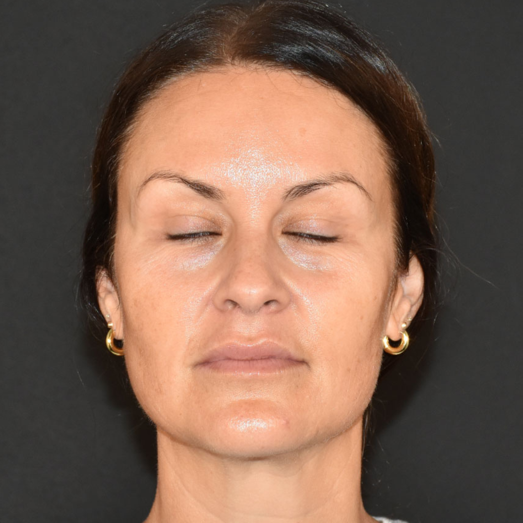 Case--3321 | After Facial Fillers