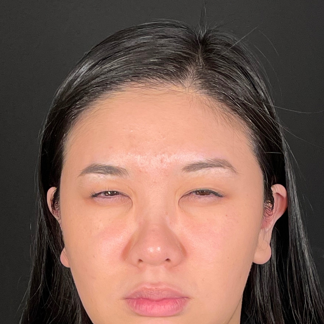 Case--6583 | After Neurotoxins