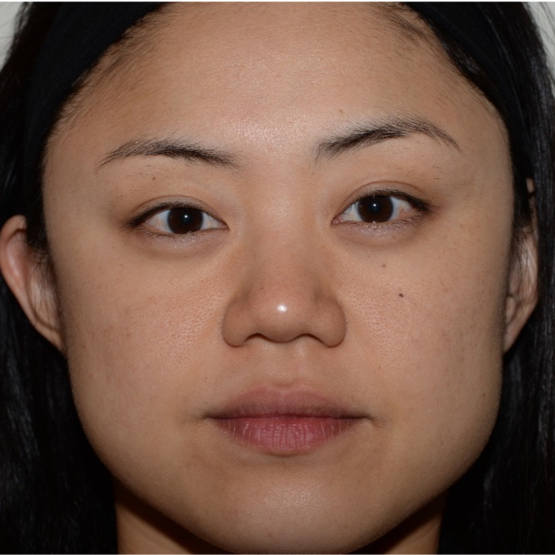 Case--6069 | After IPL & Laser Treatments 2