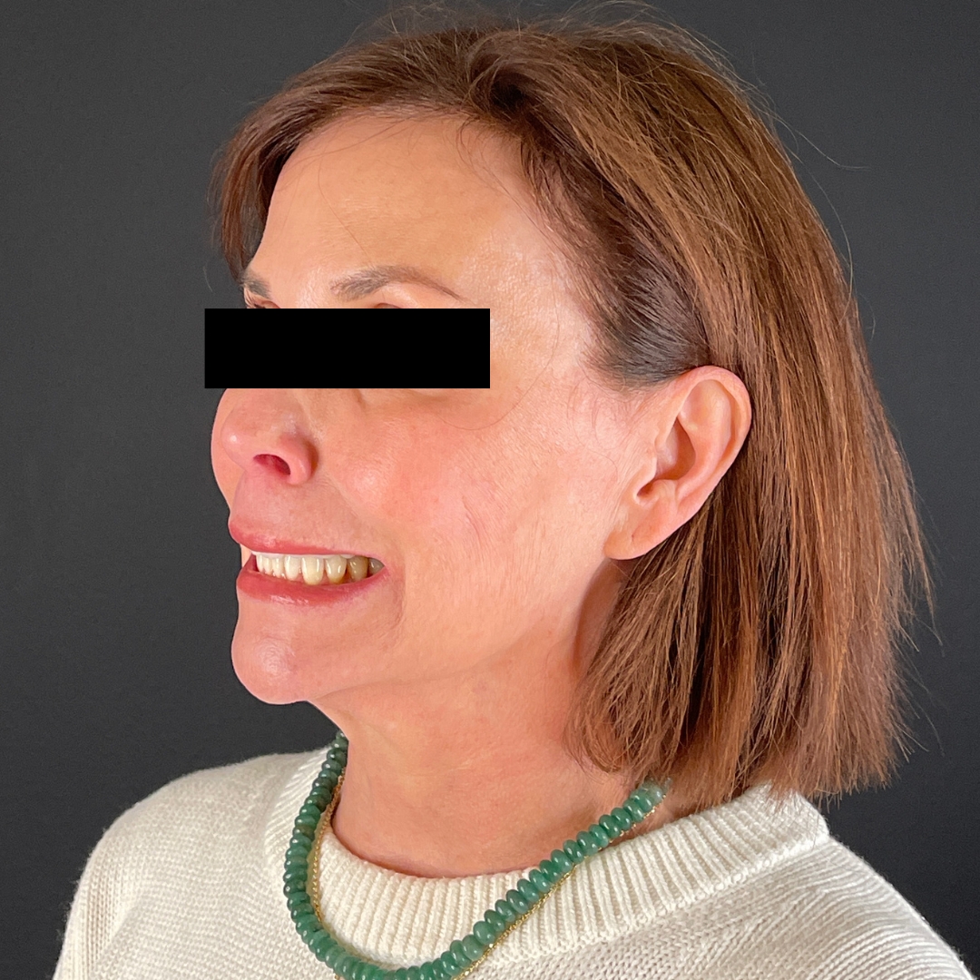 Case--6842 | After Neurotoxins