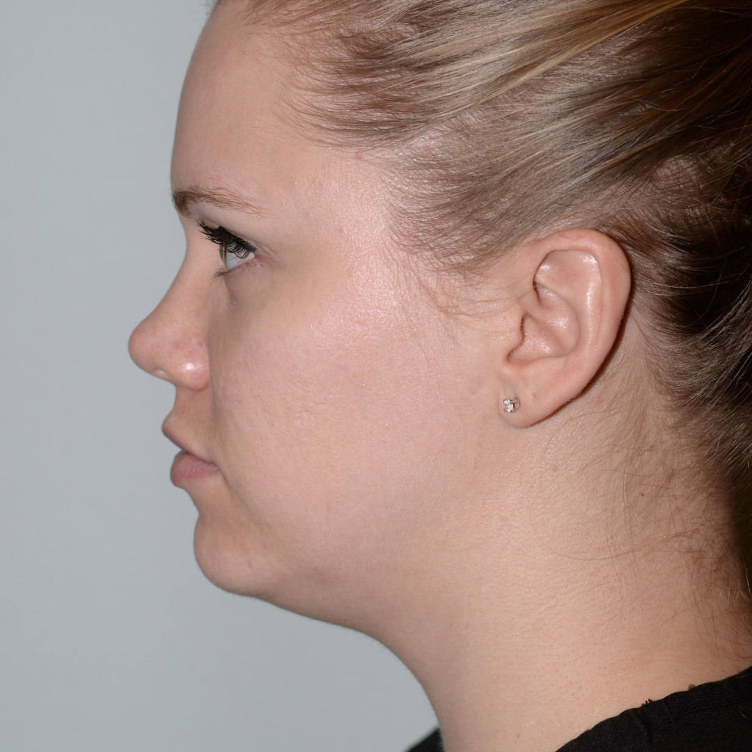 Case--3447 | After Medspa